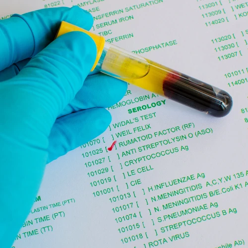 Imagen de: FACTOR REUMATOIDE