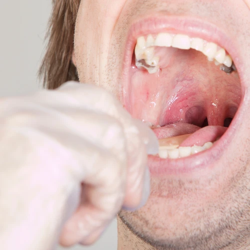 Imagen de: EXUDADO FARINGEO